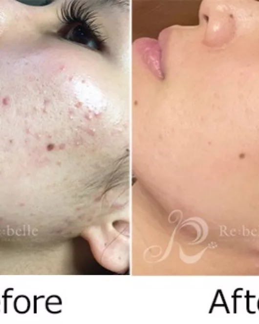 Acne Care Treatment (Herbal Peeling + Plasma)
